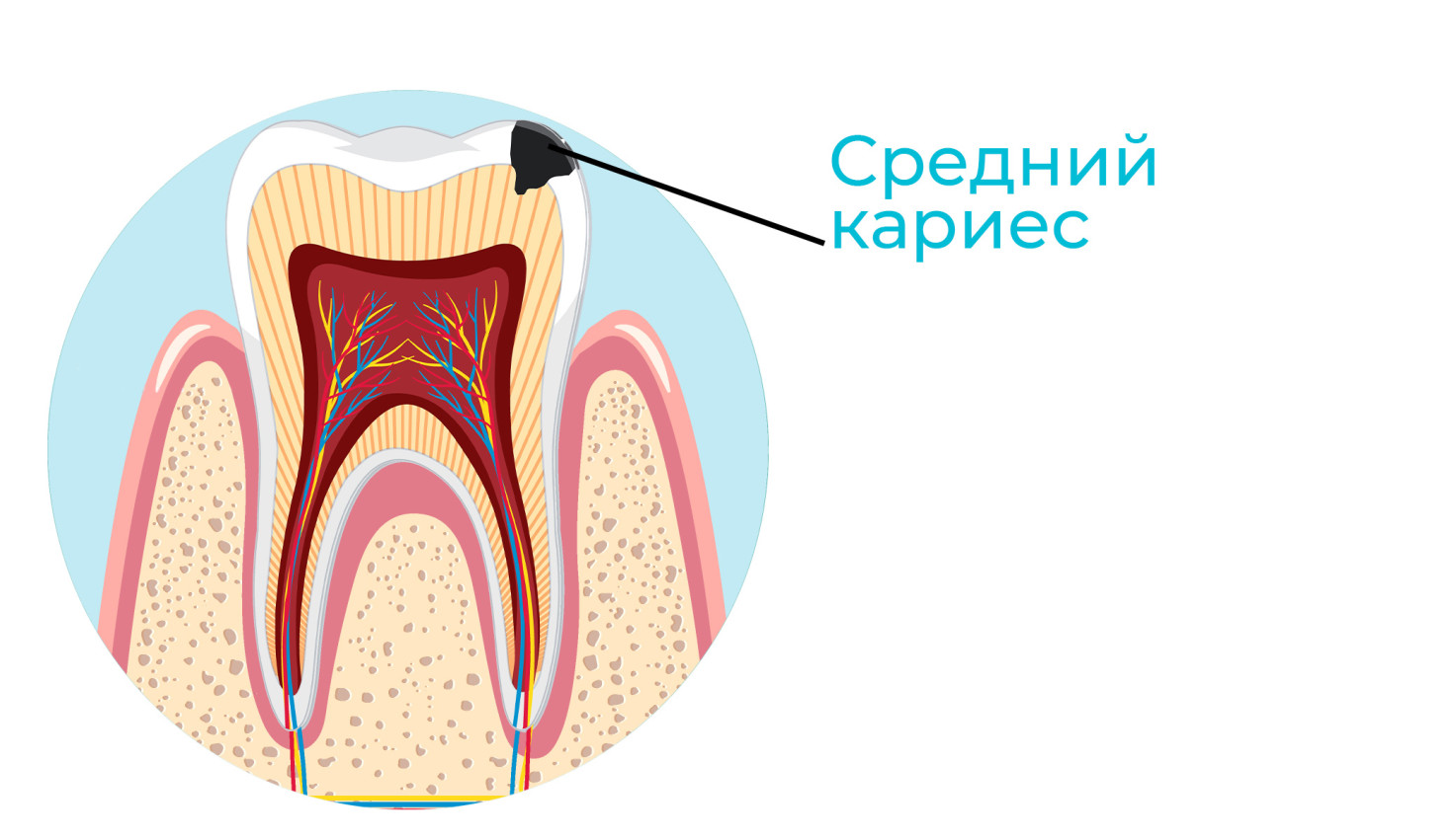 srednij karies porazhaet ehmal i dentin zuba