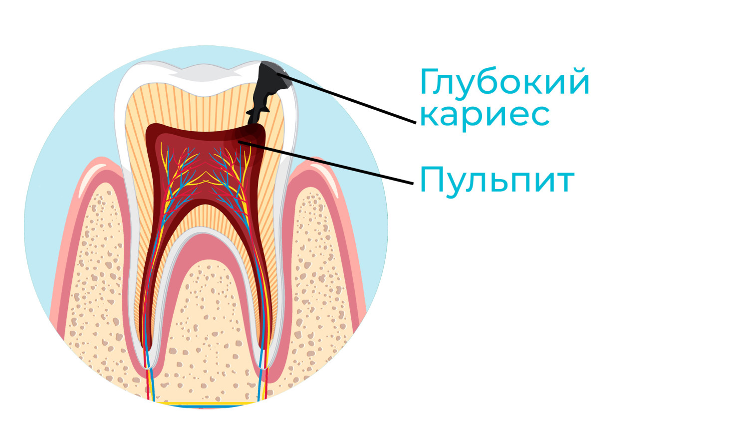 glubokij-karies-dohodit-do-pulpovoj-kamery