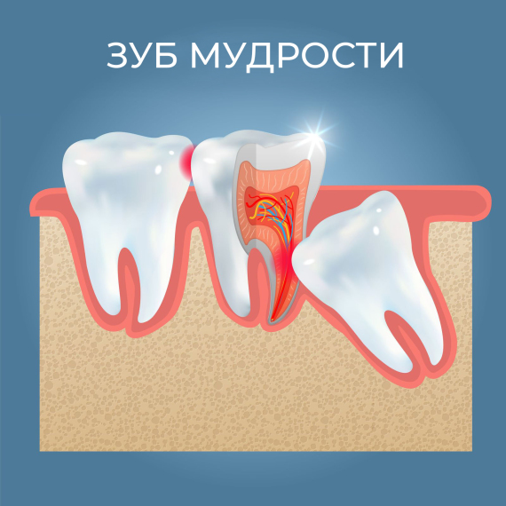 Экстракция ретинированных и дистопированных единиц